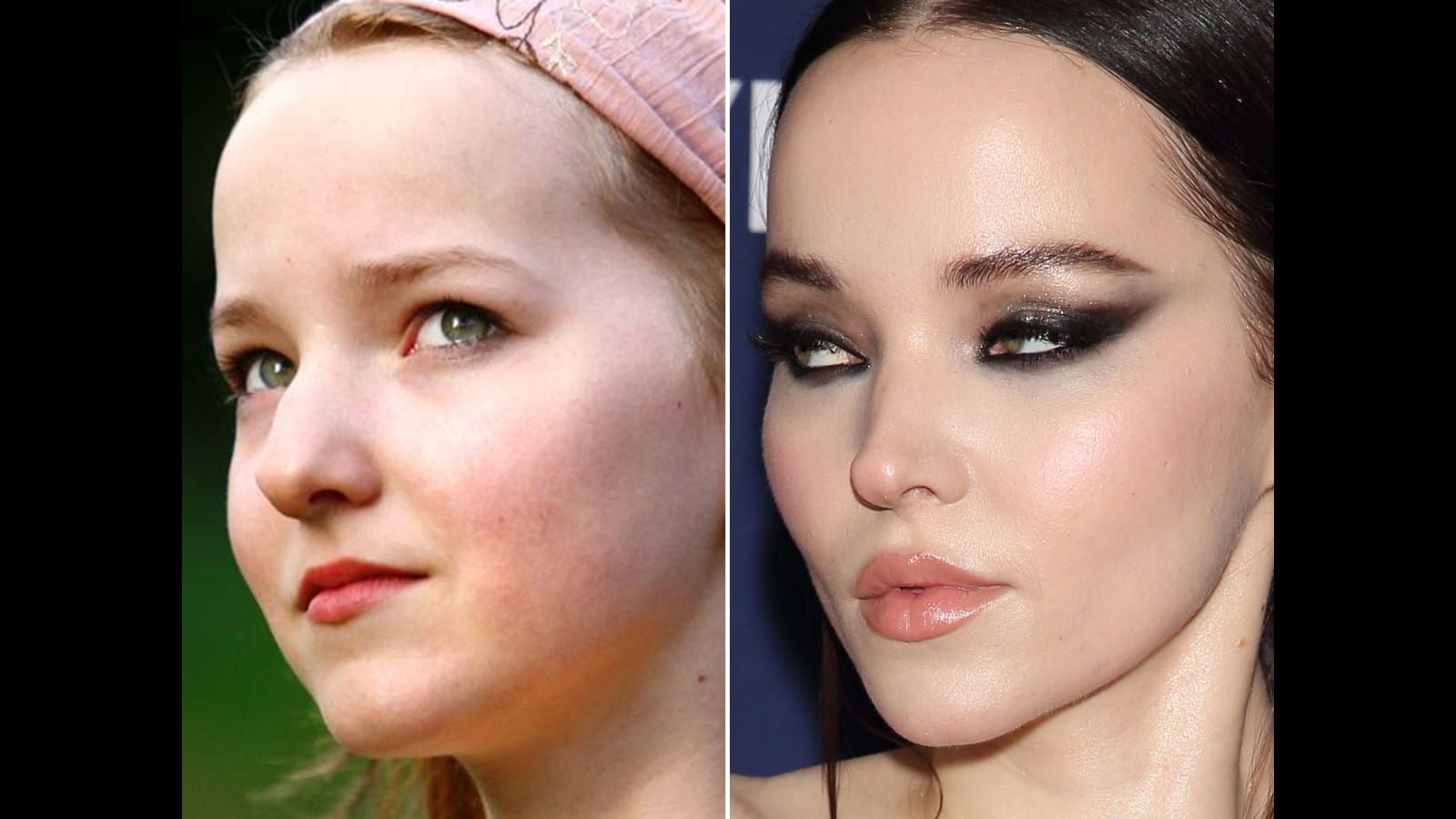 Dove Cameron’s Nose Job